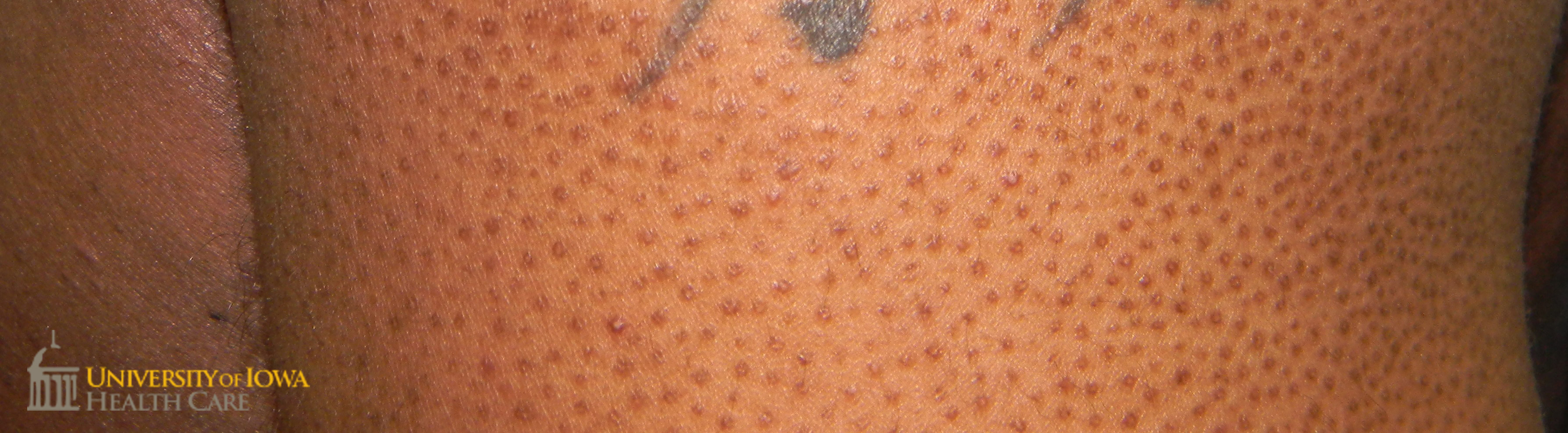 Diffuse follicular-based papules on the arm. (click images for higher resolution).